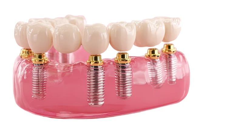 All-on-6 Dental Implant: Stronger Support, Longer Life