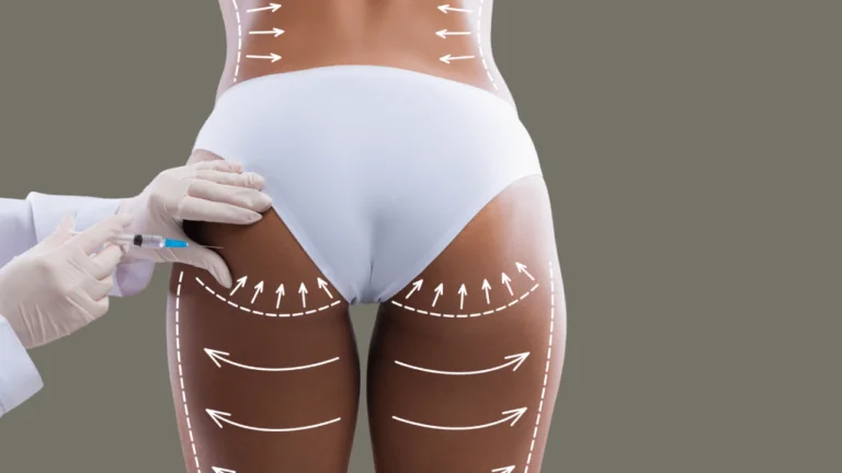 BBL (Brazilian Butt Lift): Surgery Process and Recovery Guide