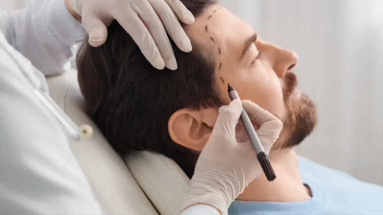 Differences Between DHI and FUE Hair Transplant