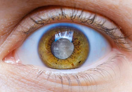 Intraocular Lens Implant