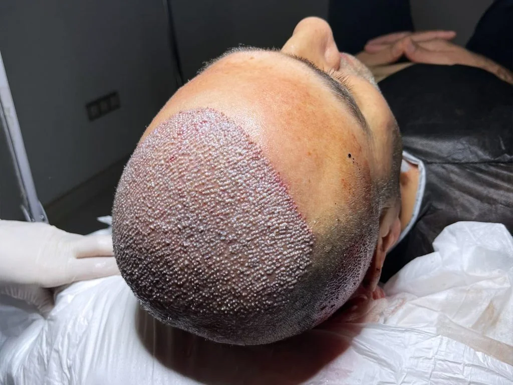 Hair Transplant